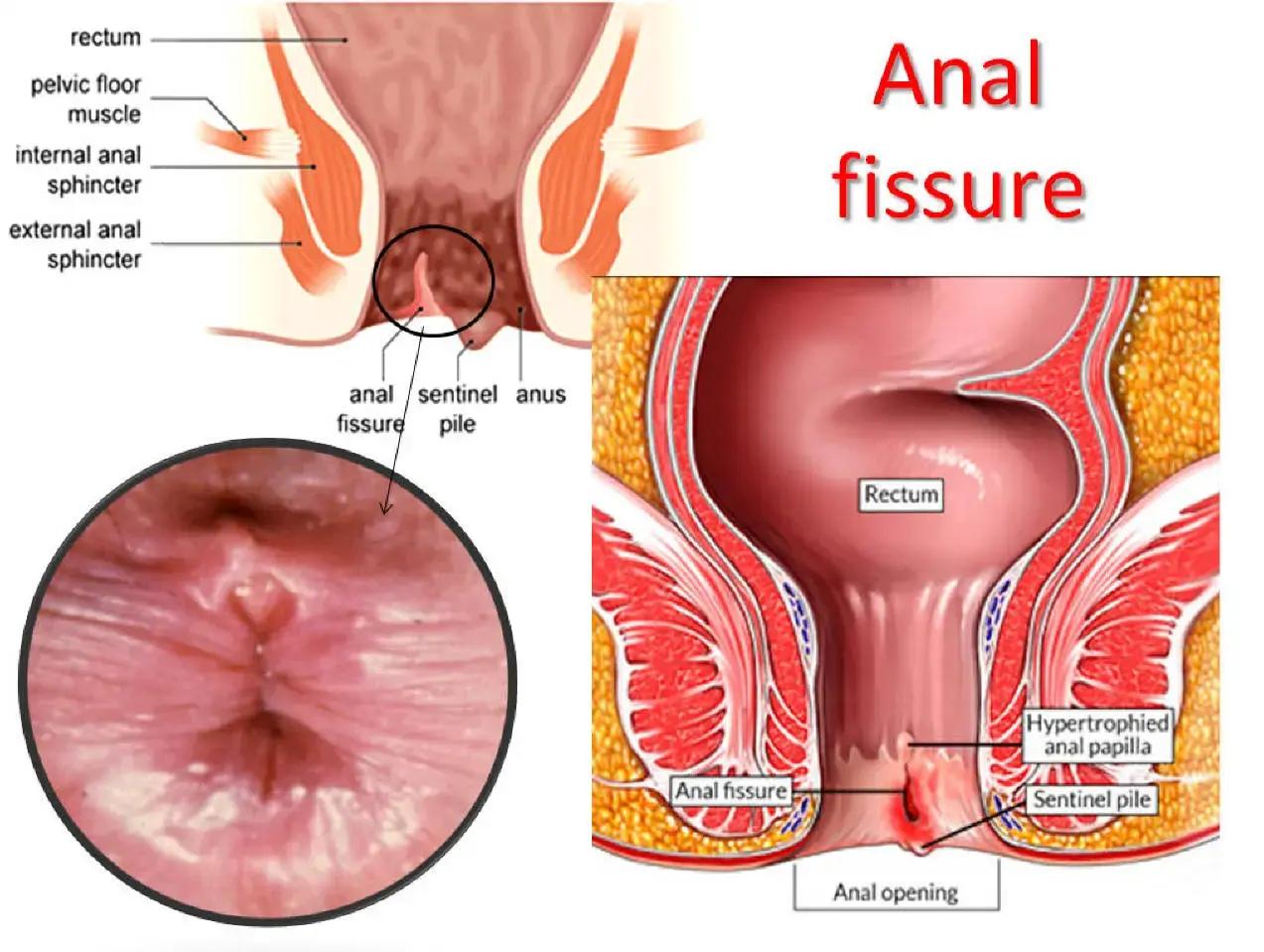 Fissure Laser Surgery